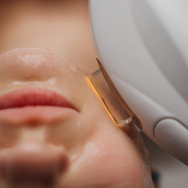 HIFU 12D | Facial