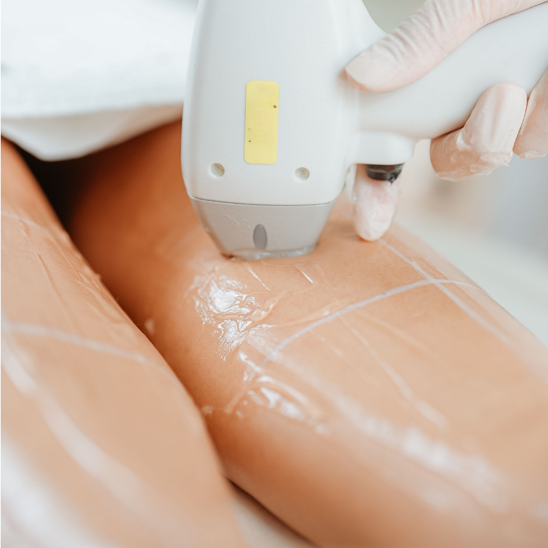 HIFU 12D | Piernas